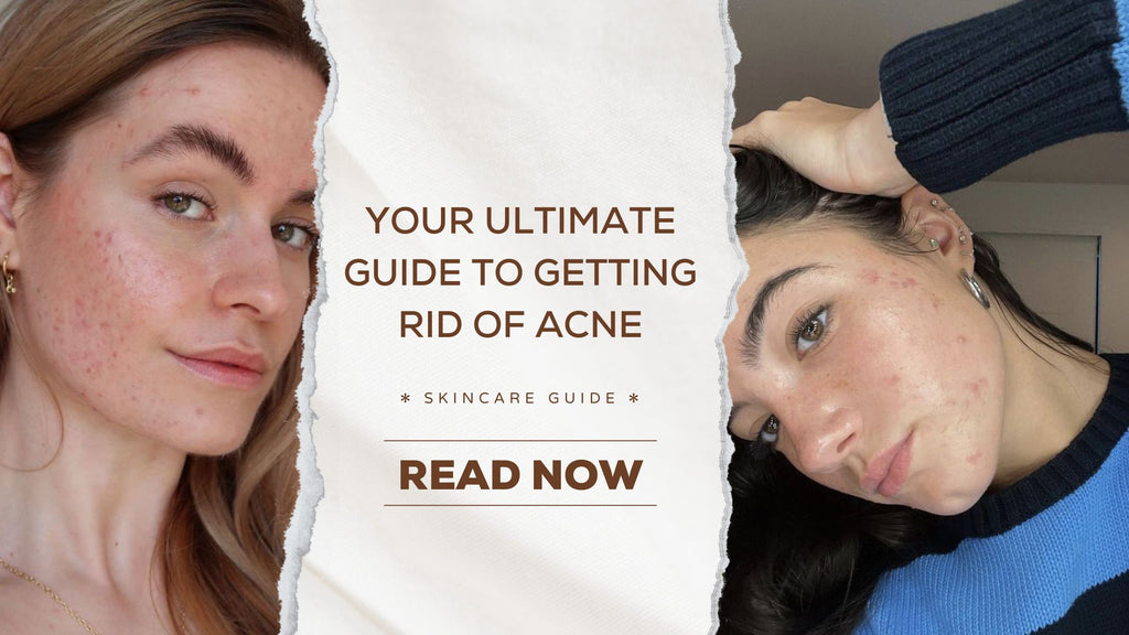 Your Ultimate Guide to Getting Rid of Acne